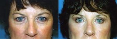 Eyelid Surgery Before & After Gallery - Patient 122405888 - Image 1