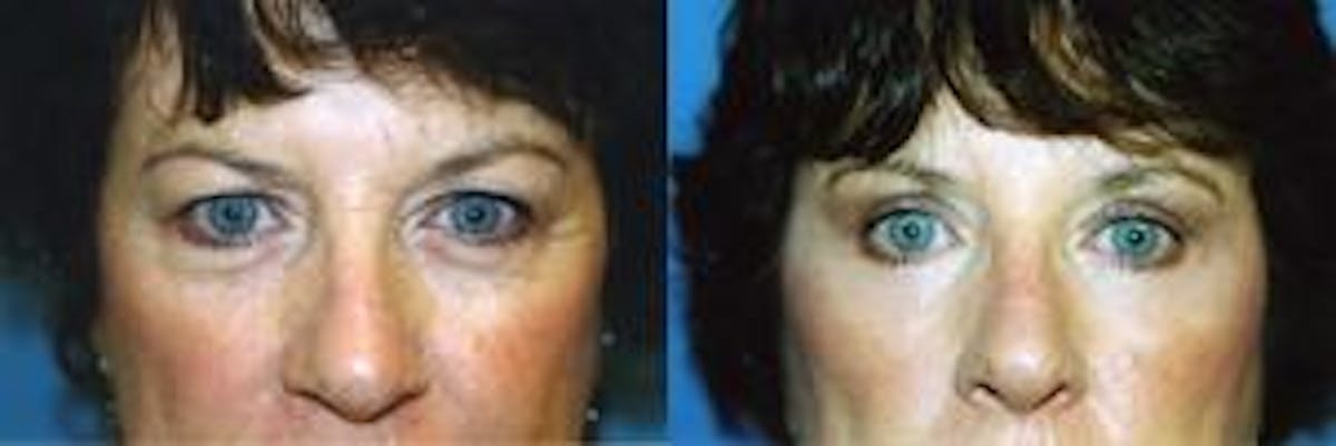 Eyelid Surgery Before & After Gallery - Patient 122405888 - Image 1