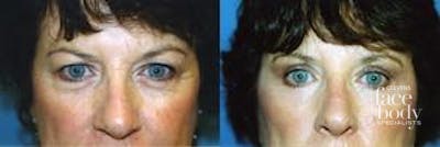 Eyelid Surgery Before & After Gallery - Patient 268550 - Image 1