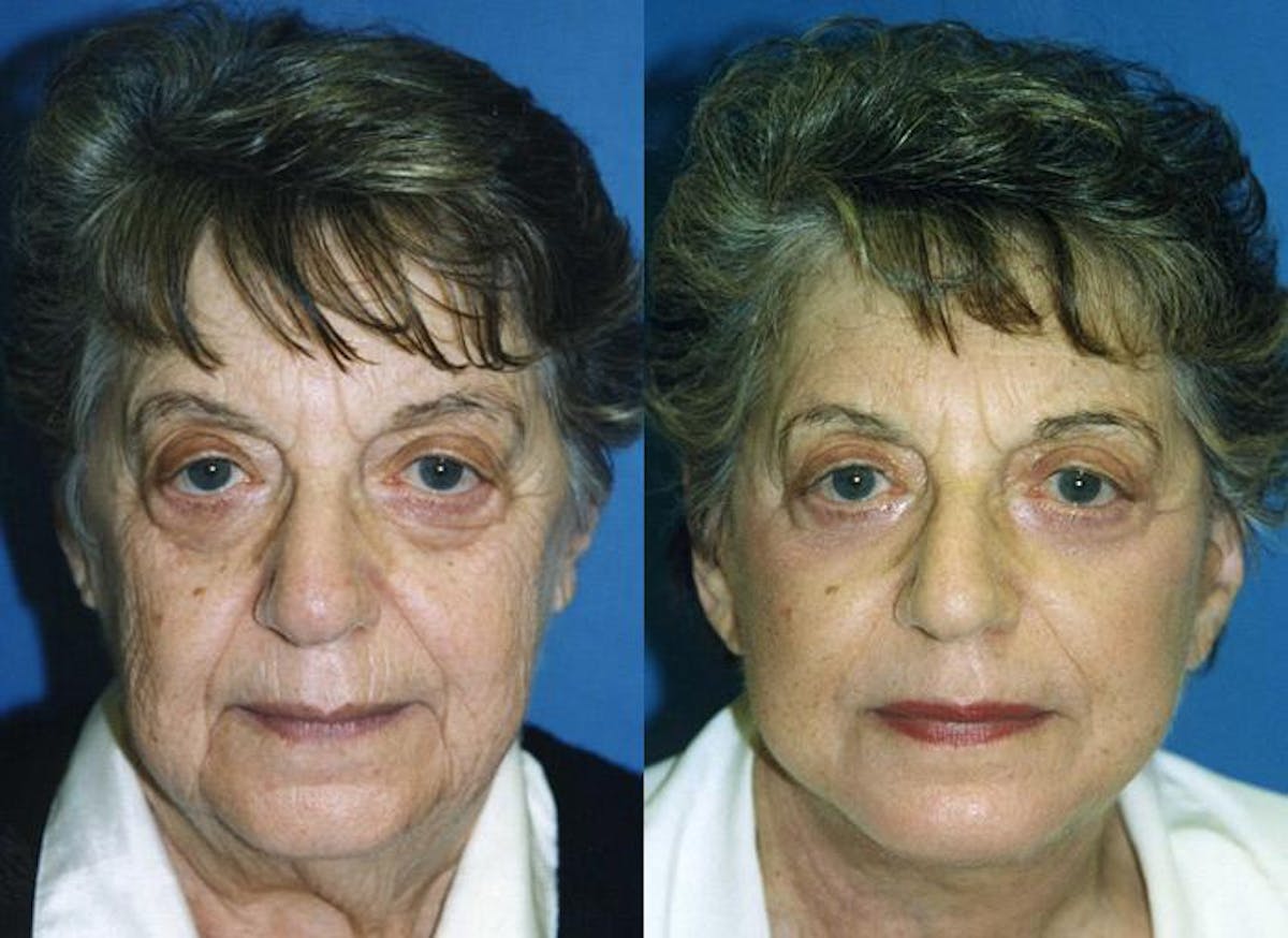 Facelift Before & After Gallery - Patient 122405889 - Image 1