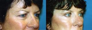 Eyelid Surgery Before & After Gallery - Patient 268550 - Image 2
