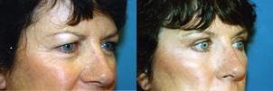 Eyelid Surgery Before & After Gallery - Patient 122405888 - Image 2