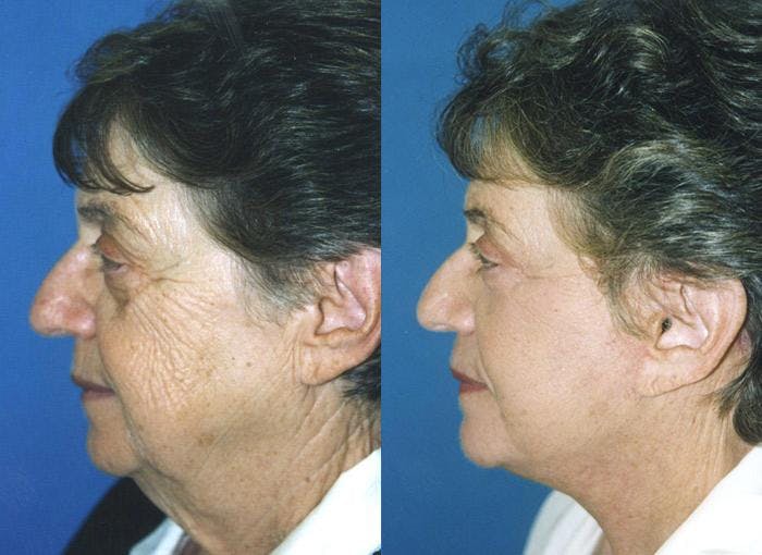 Facelift Before & After Gallery - Patient 122405889 - Image 2