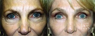 Eyelid Surgery Before & After Gallery - Patient 254437 - Image 1