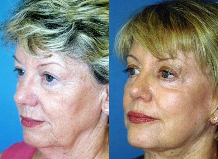 Facelift Before & After Gallery - Patient 122405891 - Image 1