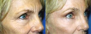 Eyelid Surgery Before & After Gallery - Patient 254437 - Image 2