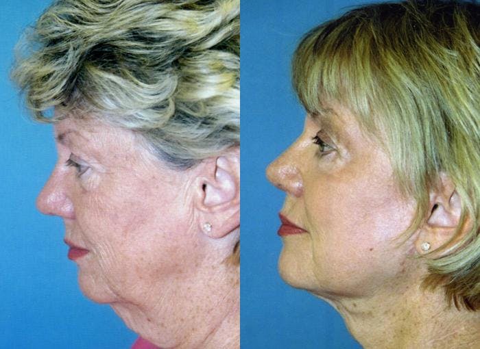 Facelift Before & After Gallery - Patient 122405891 - Image 2