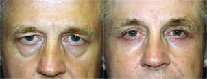 Eyelid Surgery Before & After Gallery - Patient 181110 - Image 1