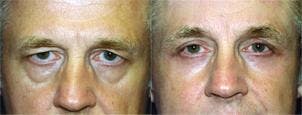 Eyelid Surgery Before & After Gallery - Patient 122405892 - Image 1