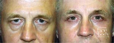Eyelid Surgery Before & After Gallery - Patient 181110 - Image 1