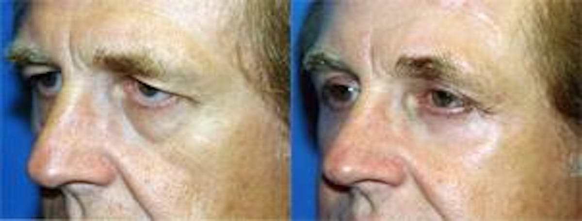 Eyelid Surgery Before & After Gallery - Patient 122405892 - Image 2