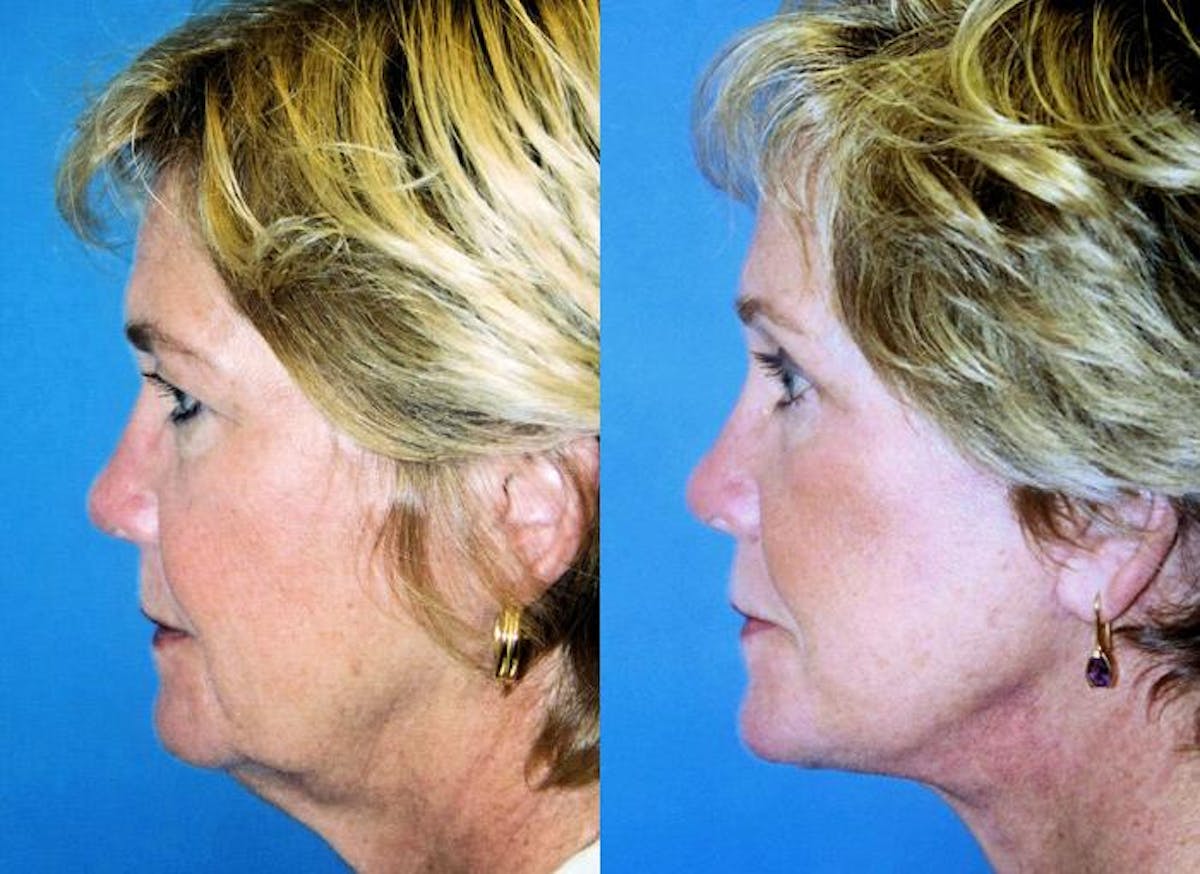 Facelift Before & After Gallery - Patient 122405893 - Image 1