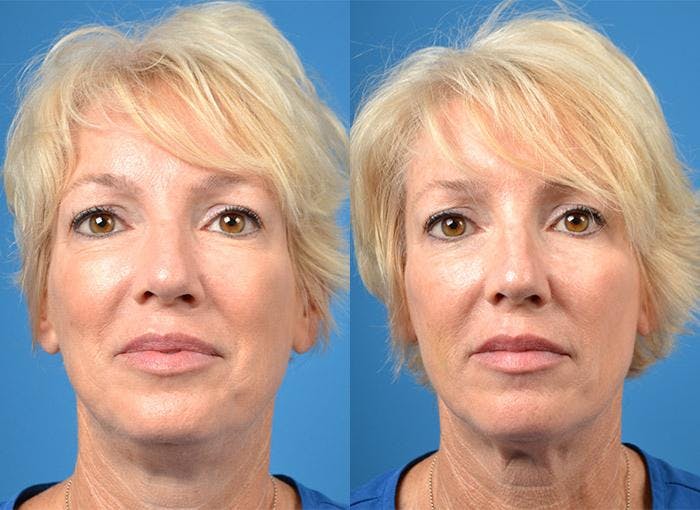Kybella Before & After Gallery - Patient 122405898 - Image 1