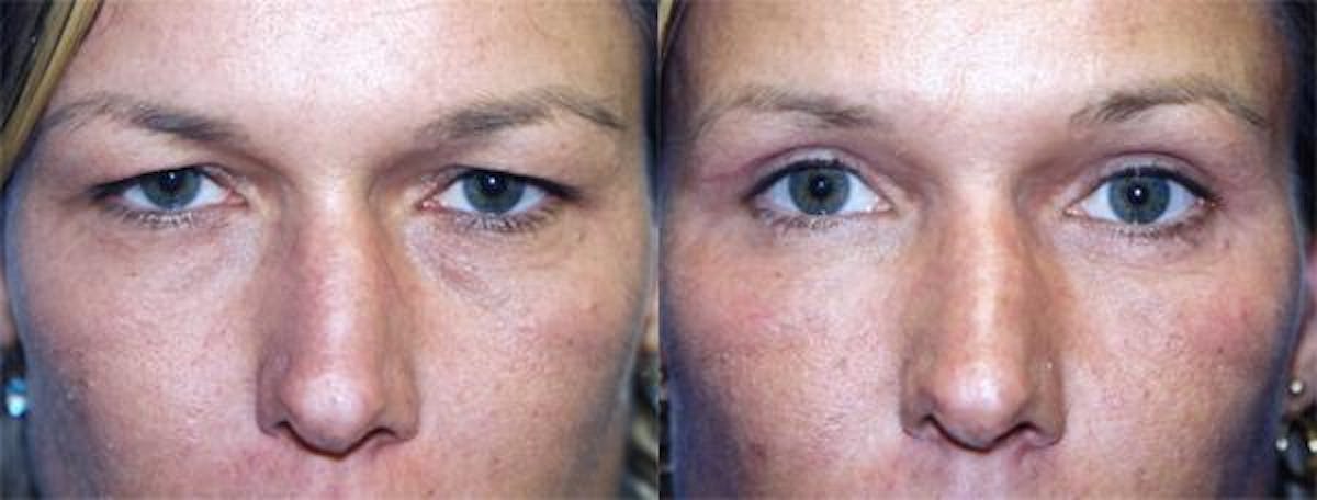 Eyelid Surgery Before & After Gallery - Patient 122405895 - Image 1