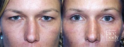 Eyelid Surgery Before & After Gallery - Patient 581379 - Image 1