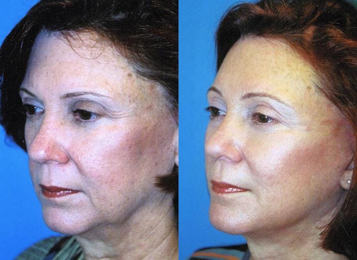 Facelift Before & After Gallery - Patient 122405894 - Image 1