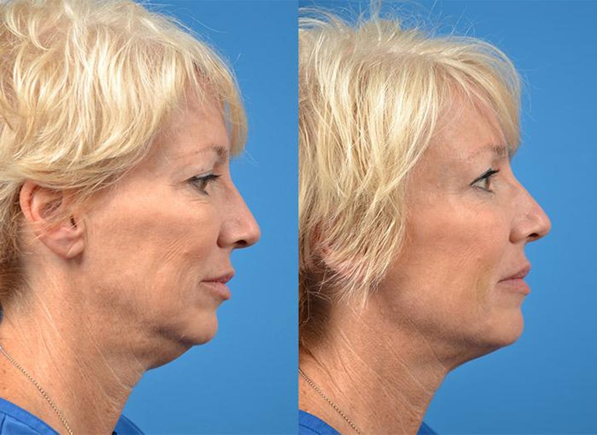 Kybella Before & After Gallery - Patient 122405898 - Image 2