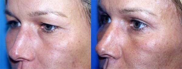 Eyelid Surgery Before & After Gallery - Patient 122405895 - Image 2