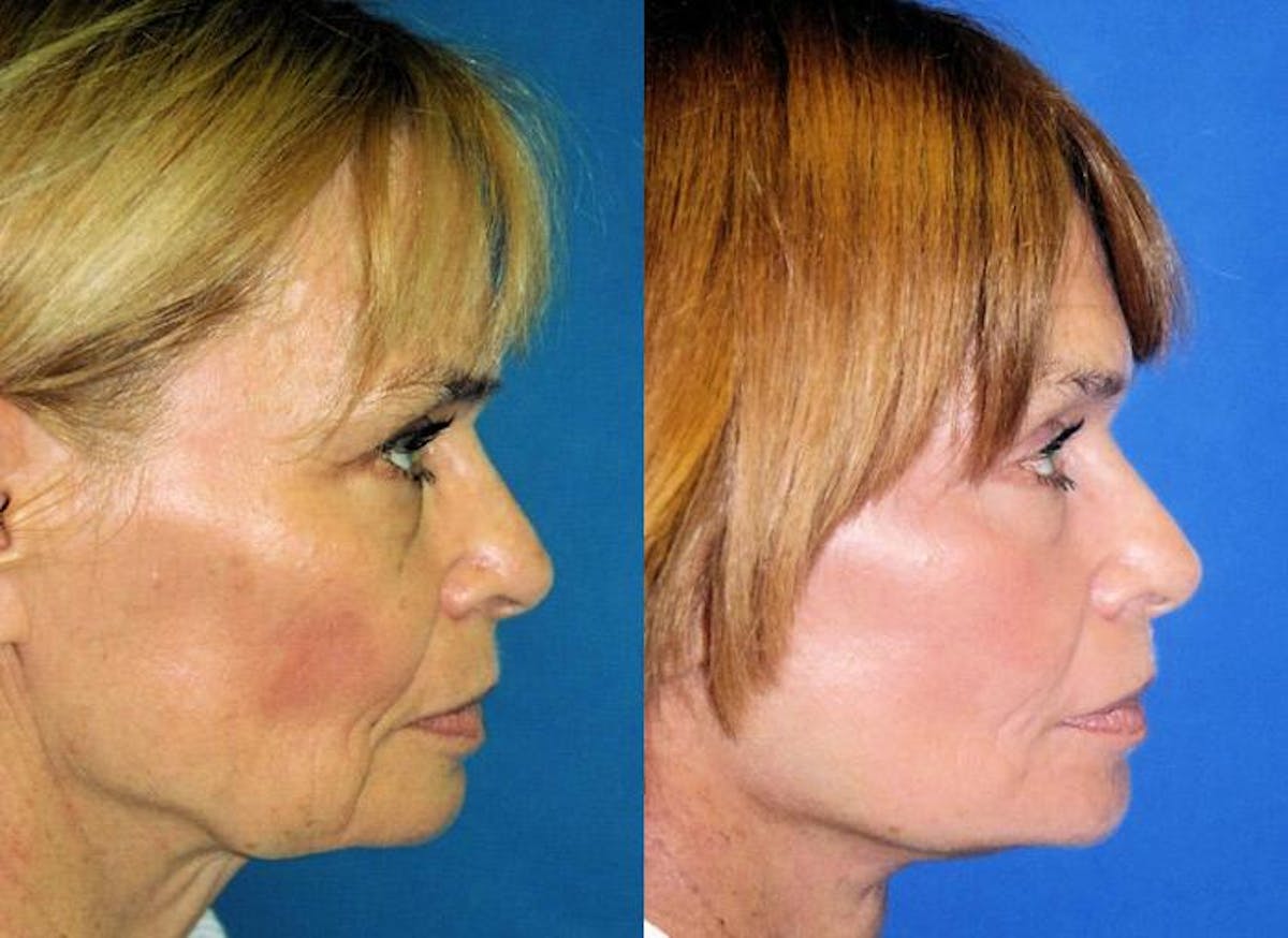 Facelift Before & After Gallery - Patient 122405896 - Image 1