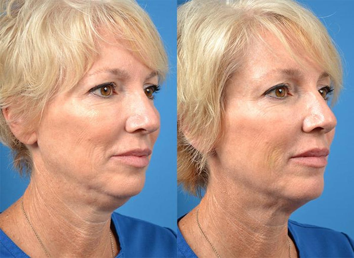 Kybella Before & After Gallery - Patient 122405898 - Image 3
