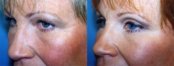 Eyelid Surgery Before & After Gallery - Patient 122405897 - Image 1