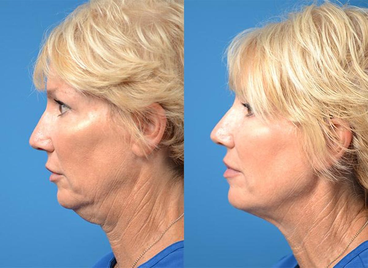 Kybella Before & After Gallery - Patient 122405898 - Image 4