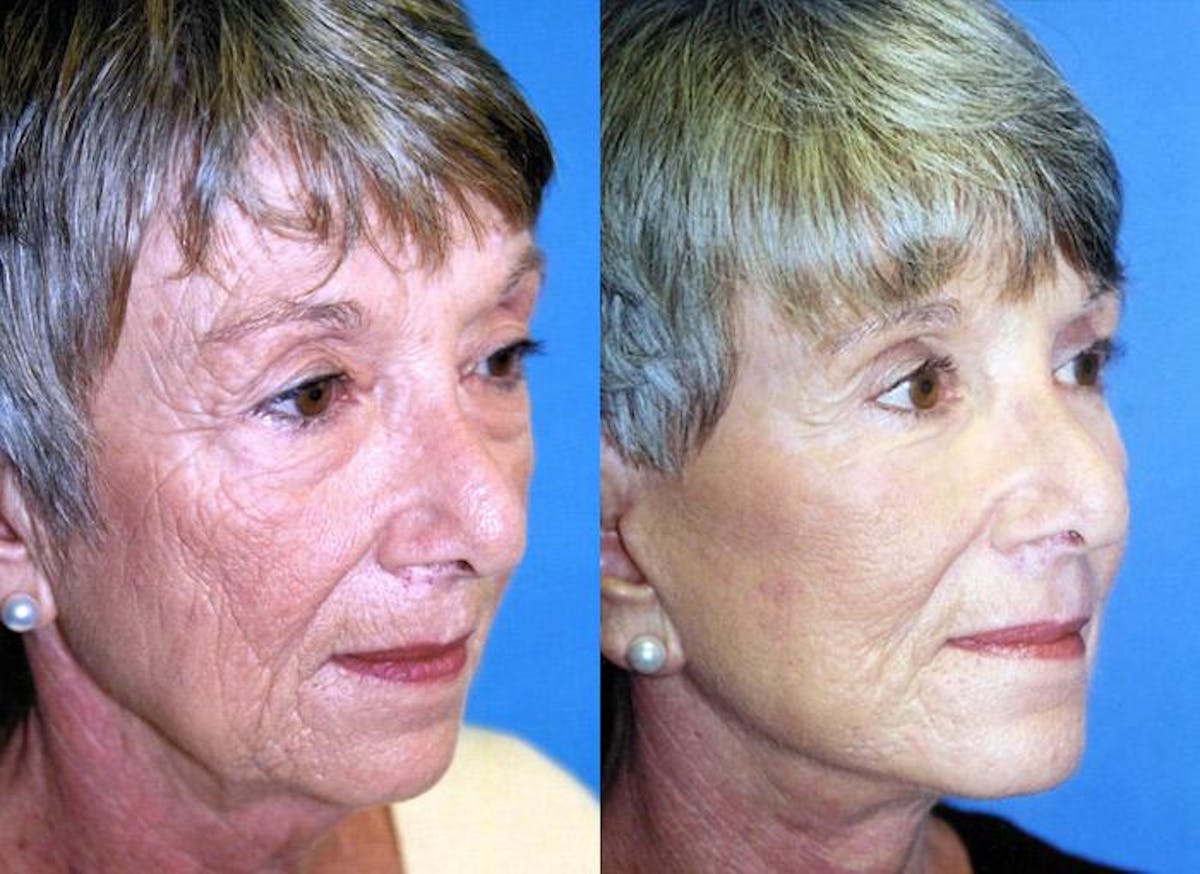 Facelift Before & After Gallery - Patient 122405901 - Image 1