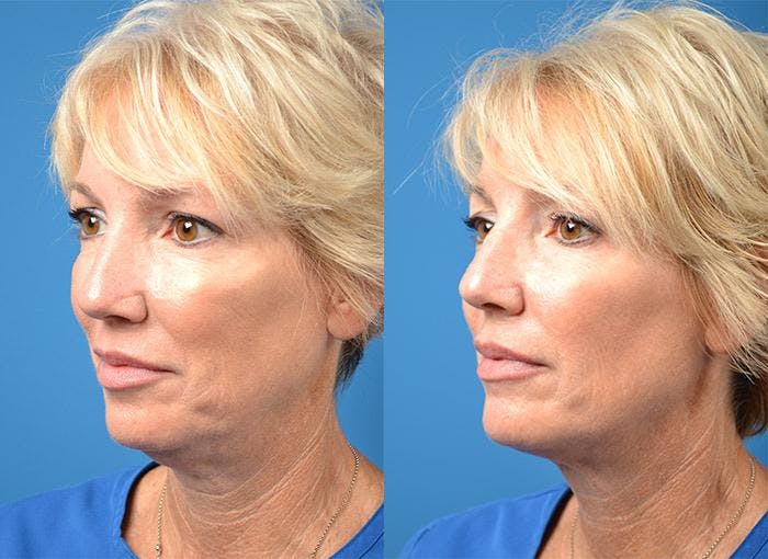 Kybella Before & After Gallery - Patient 122405898 - Image 5