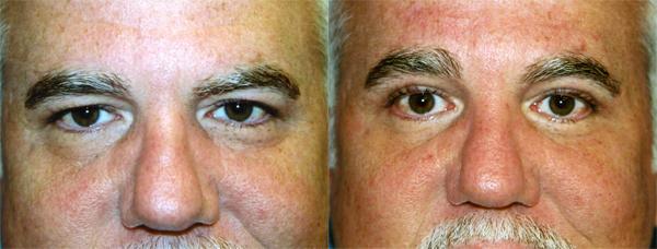 Eyelid Surgery Before & After Gallery - Patient 134522 - Image 1