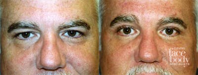 Eyelid Surgery Before & After Gallery - Patient 134522 - Image 1