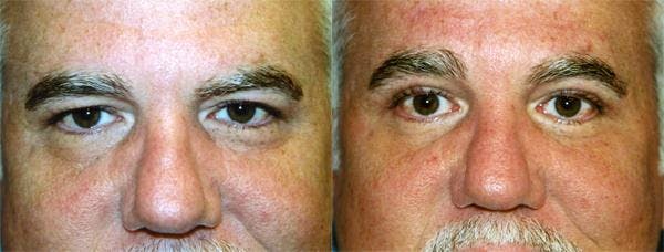 Eyelid Surgery Before & After Gallery - Patient 122405899 - Image 1