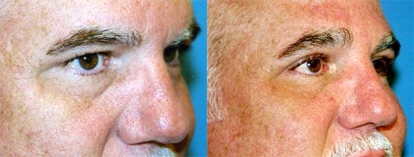 Eyelid Surgery Before & After Gallery - Patient 122405899 - Image 2