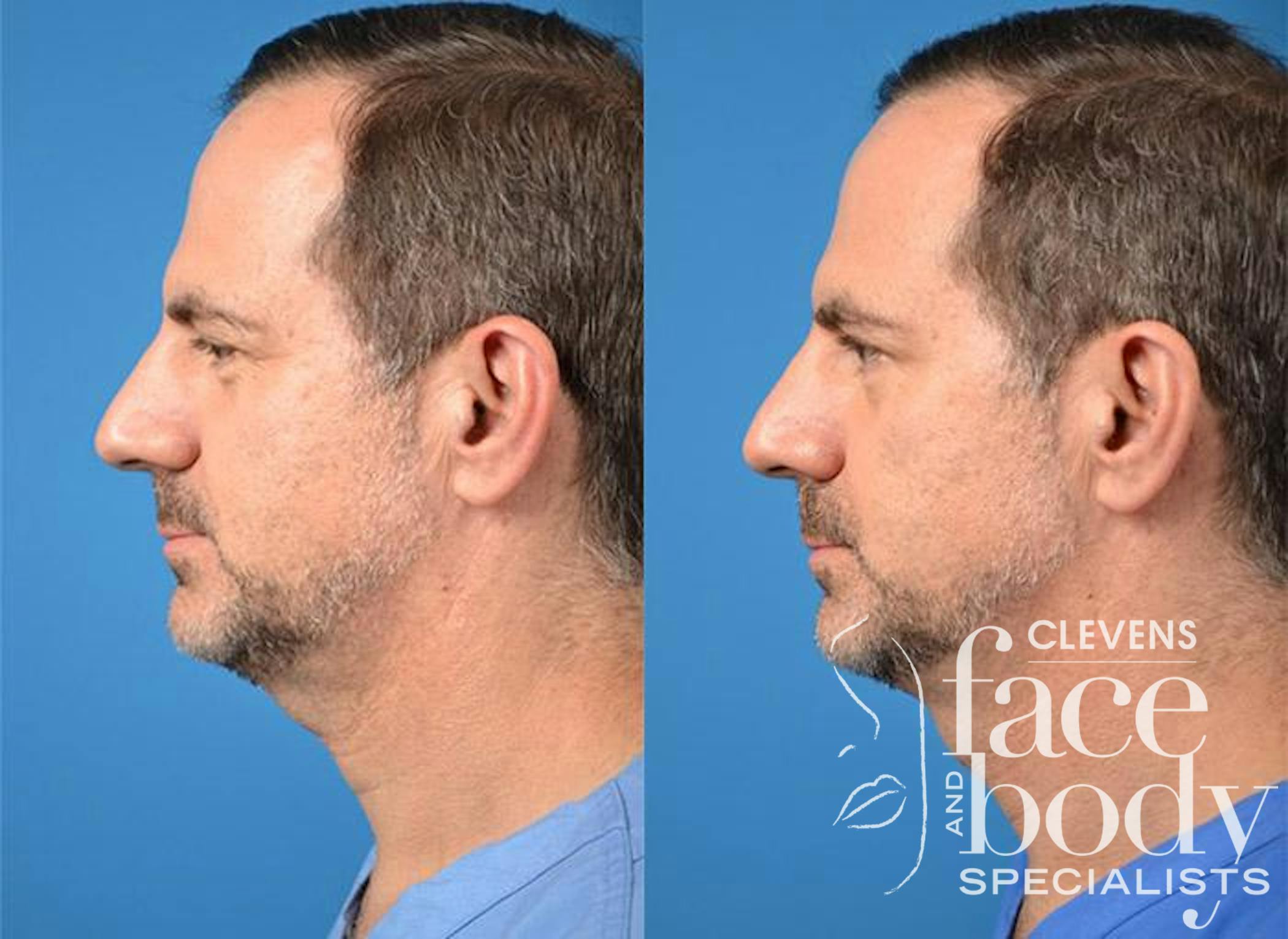 Kybella Procedure