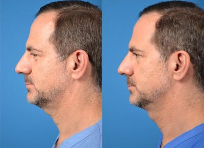 Kybella Before & After Gallery - Patient 122405900 - Image 1