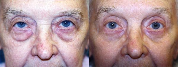 Eyelid Surgery Before & After Gallery - Patient 412540 - Image 1