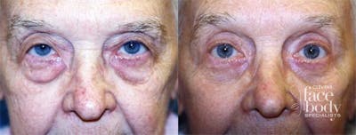 Eyelid Surgery Before & After Gallery - Patient 412540 - Image 1