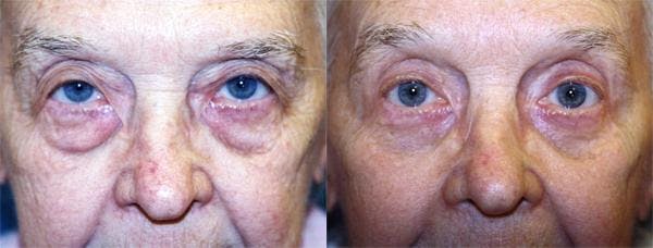Eyelid Surgery Before & After Gallery - Patient 122405902 - Image 1