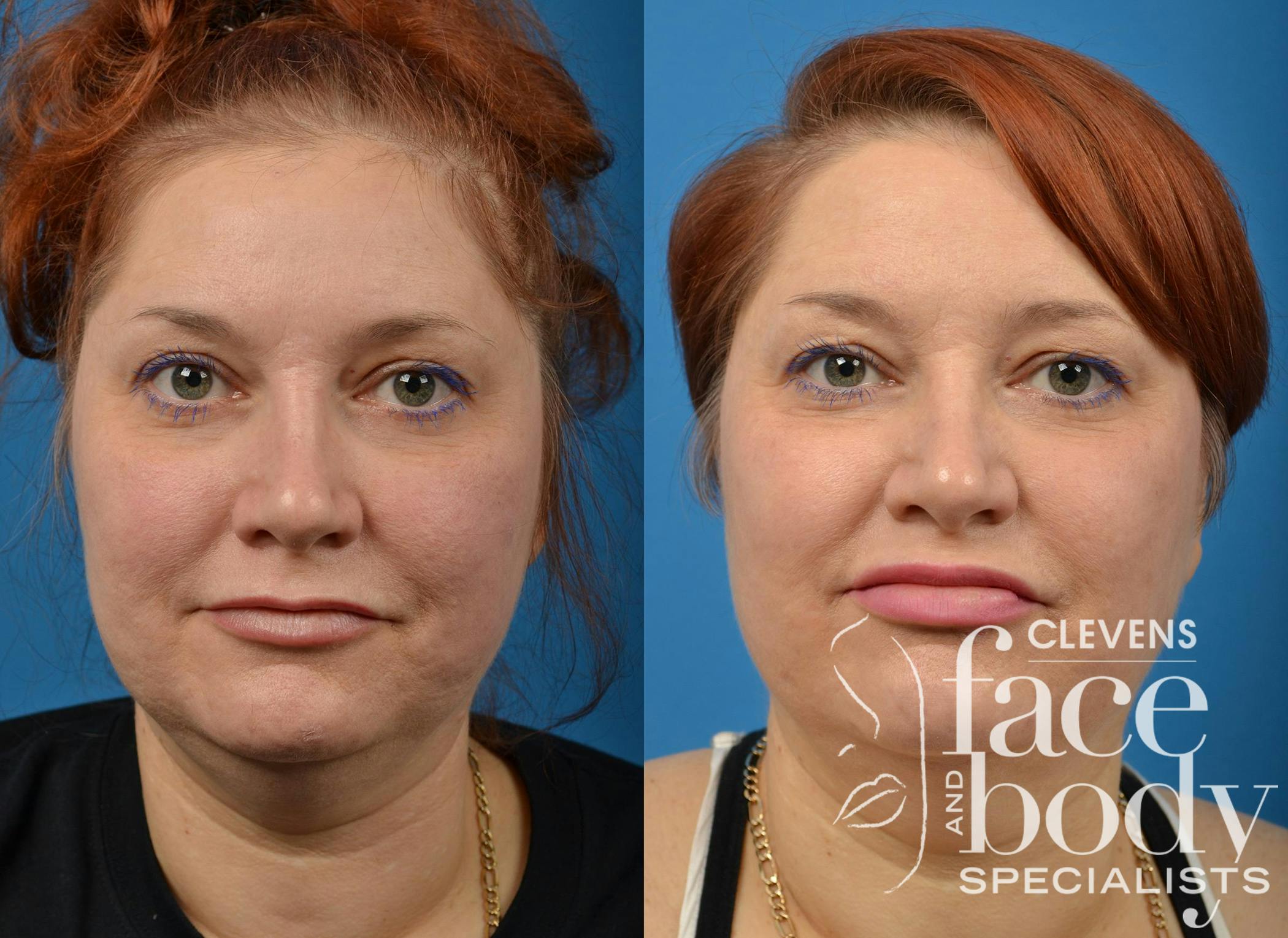 Kybella Procedure