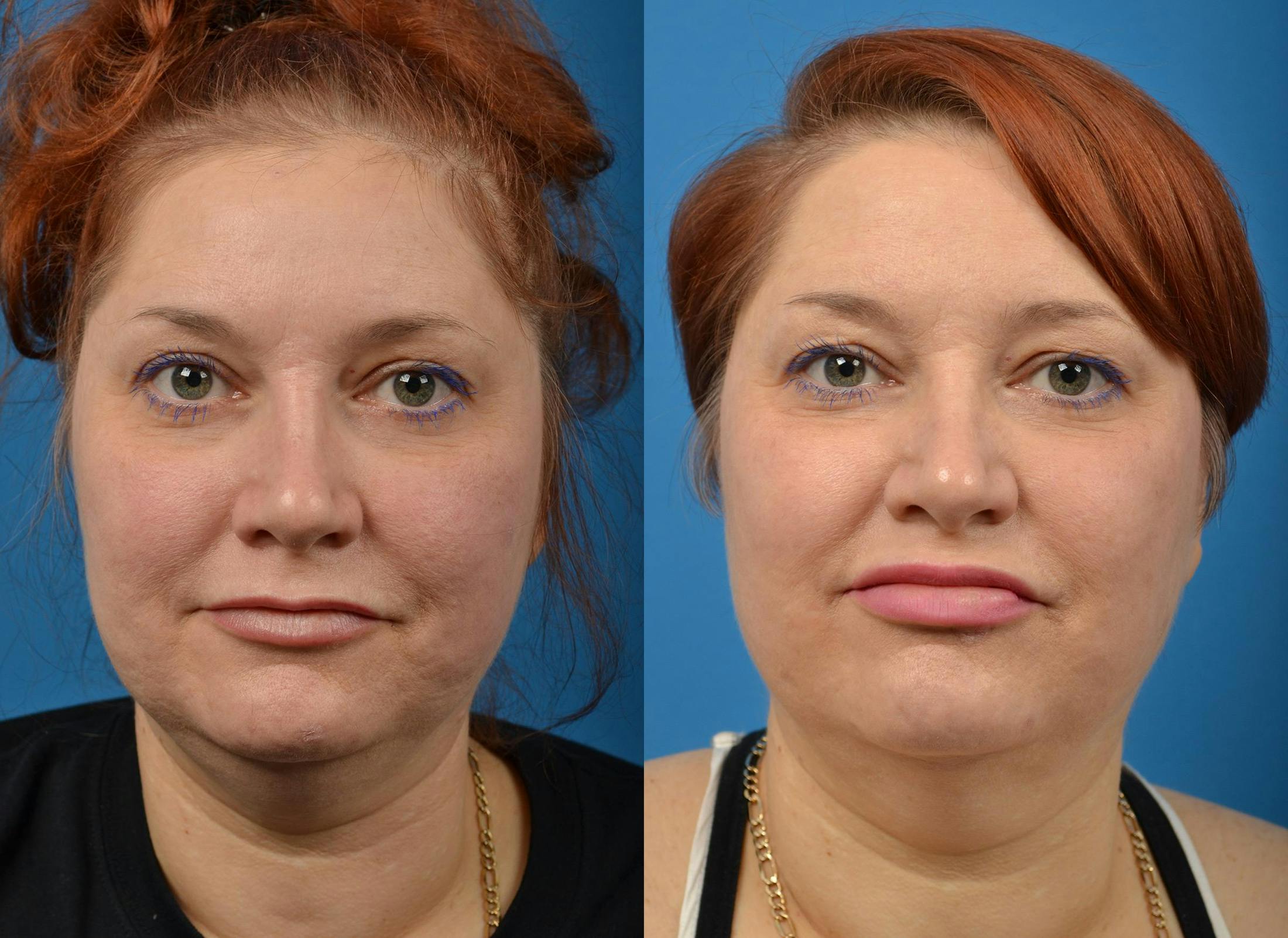 Kybella Before & After Gallery - Patient 122405909 - Image 1