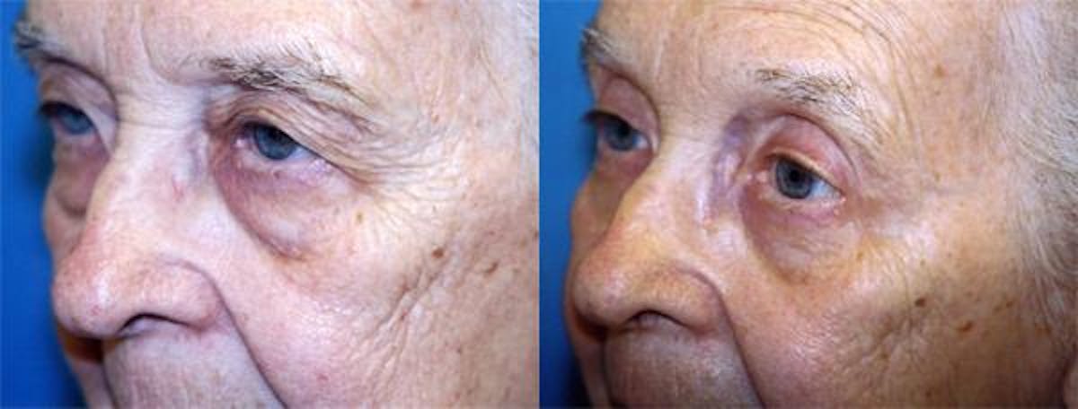Eyelid Surgery Before & After Gallery - Patient 122405902 - Image 2