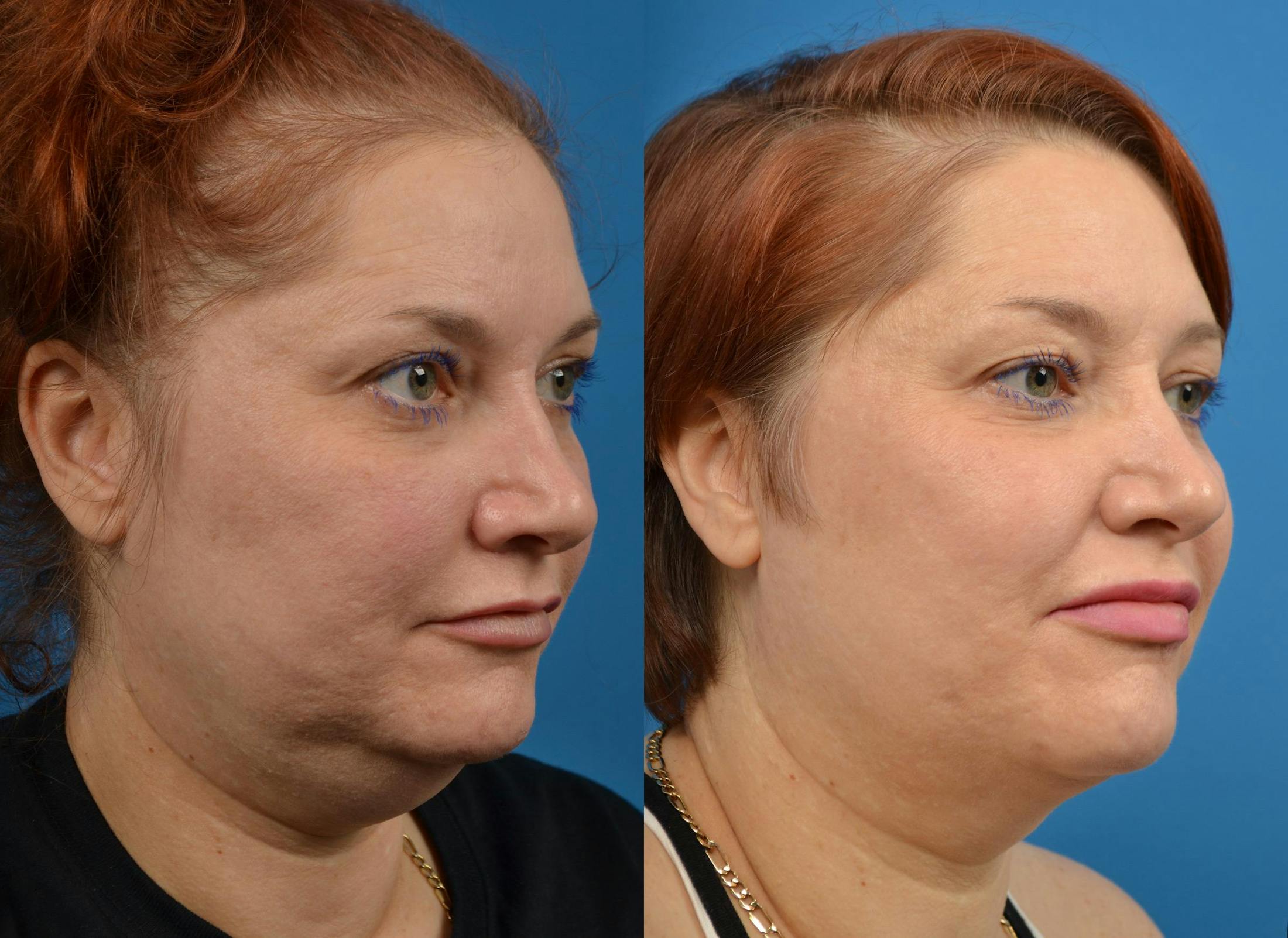 Kybella Before & After Gallery - Patient 122405909 - Image 2