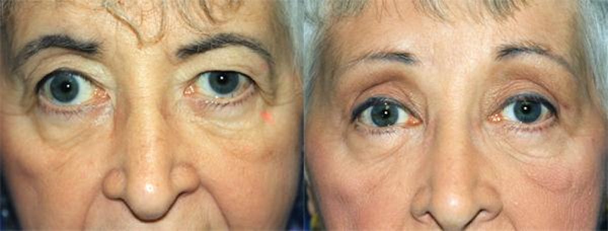 Eyelid Surgery Before & After Gallery - Patient 122405904 - Image 1