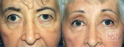 Eyelid Surgery Before & After Gallery - Patient 362547 - Image 1