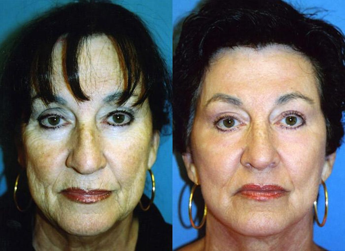 Facelift Before & After Gallery - Patient 122405905 - Image 1