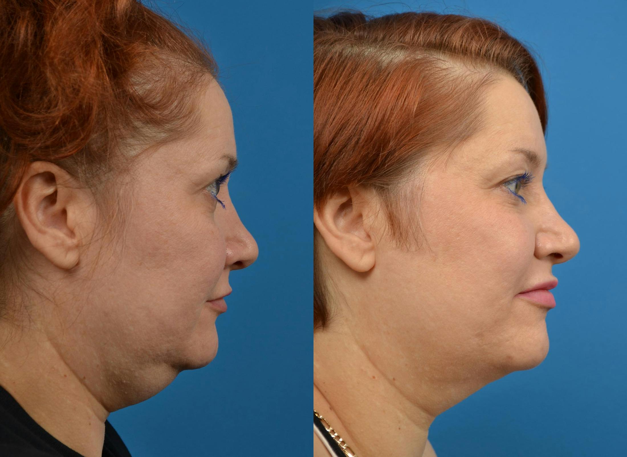 Kybella Before & After Gallery - Patient 122405909 - Image 3