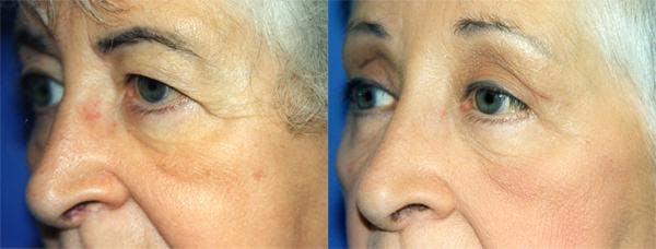 Eyelid Surgery Before & After Gallery - Patient 122405904 - Image 2