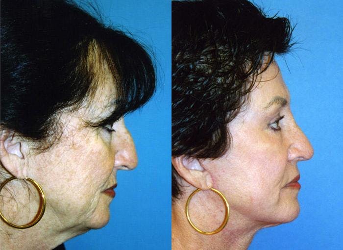 Facelift Before & After Gallery - Patient 122405905 - Image 2