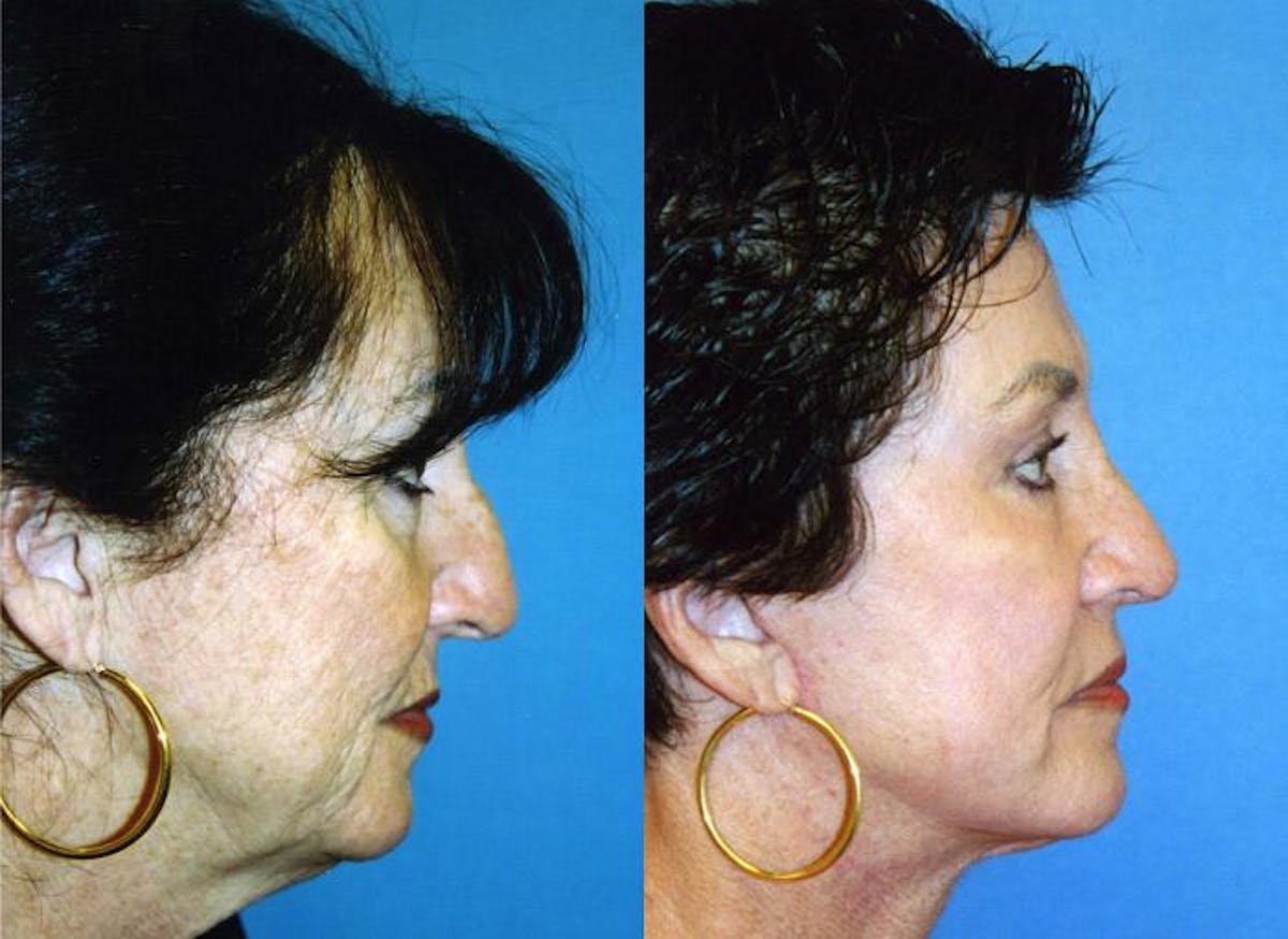 Facelift Before & After Gallery - Patient 122405905 - Image 2