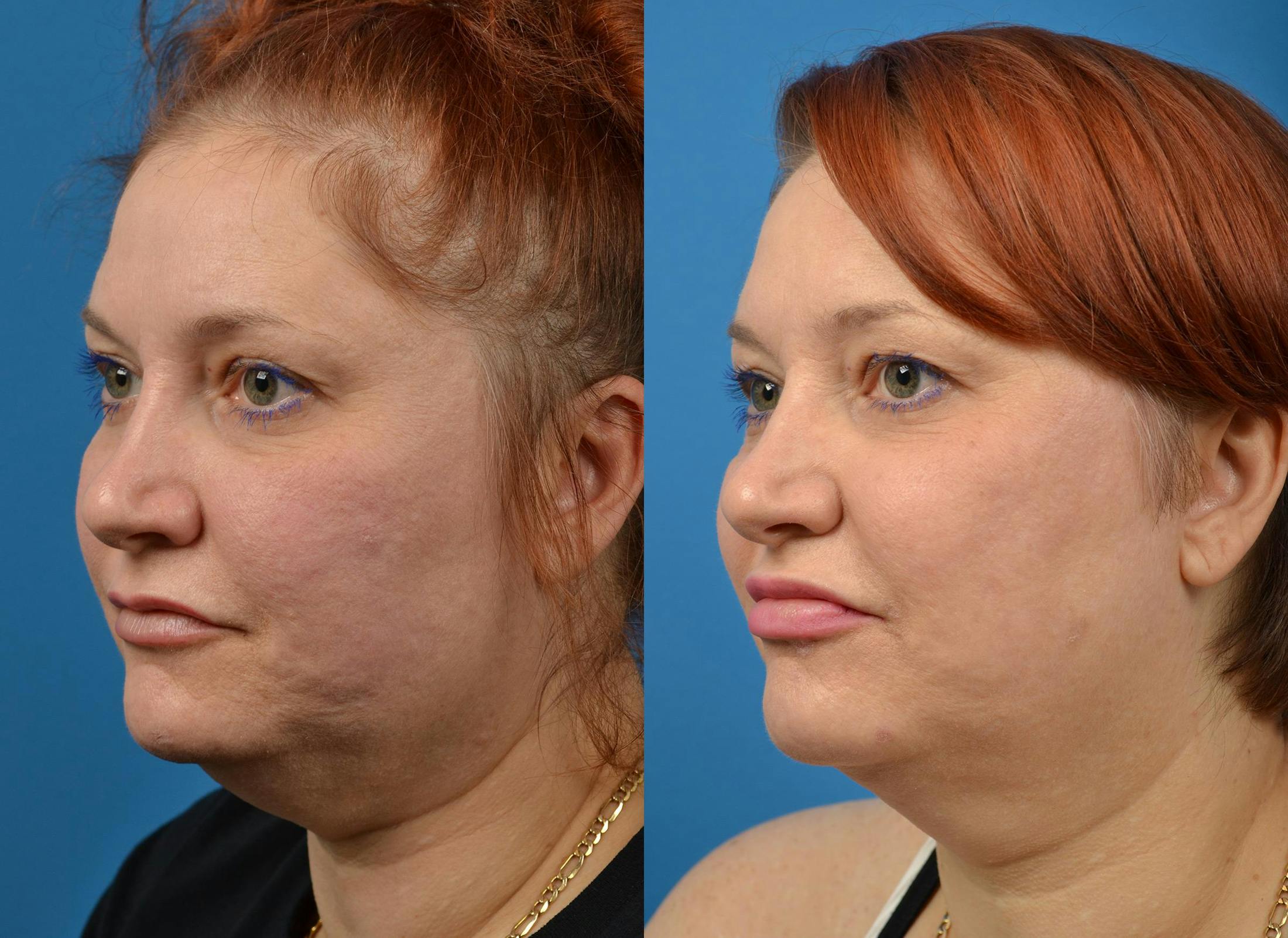 Kybella Before & After Gallery - Patient 122405909 - Image 4