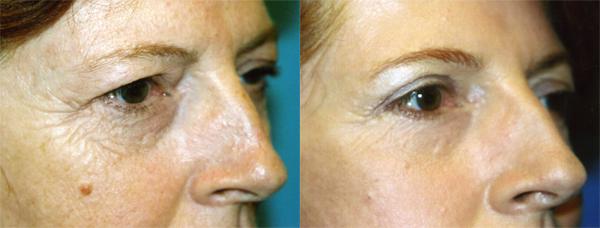 Eyelid Surgery Before & After Gallery - Patient 331973 - Image 1